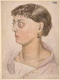 The medical term for bulging eyes is exophthalmos. Exophthalmus Wikipedia