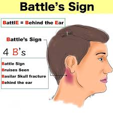 Look up basilar skull fracture