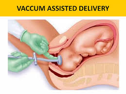 Image result for Vacuum Caput