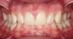 How long should you wear braces? Quiz Do I Need Braces South Surrey Smiles