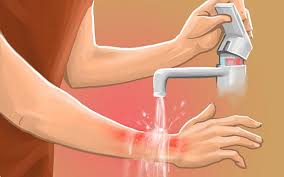 How To Treat A Burn Home Remedies For Burns Burn Remedy First Aid For Burns