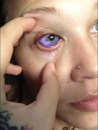 40 ultimate eye tattoo designs. Model S Botched Eyeball Tattoo The Dangers Of Sclera Tattooing Live Science