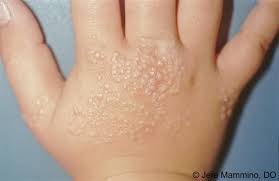Lichen Nitidus Lichen Dermatology Fitness Diet
