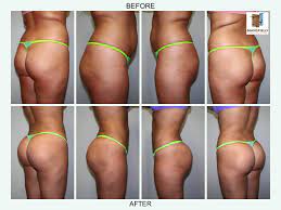Cosmetic surgery must be customized to the person receiving it. Brazilian Butt Lift 360 Lipo Mansfield Arlington Dallas Ft Worth
