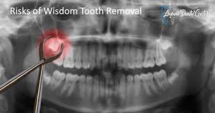 Image result for Tooth Extraction