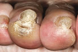 Image result for Onycholysis feet