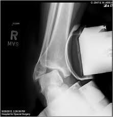 Image result for Talar Tilt