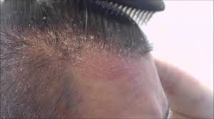 No, scalp psoriasis isn't contagious in any way. Best Ways To Get Rid Of Hair Psoriasis Follow The Remedies