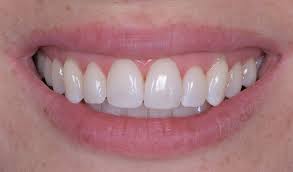 Aesthetic dental care featured newhall, ca 91321, usa phone: Smile Makeover By Newhall Street Dentist Dr Chetan Sharma