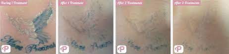 I am excited to share these results. Laser Tattoo Removal Before And After Photos Premium Tattoo Removal