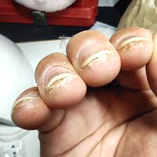 Q&A] ネイル歴2年おじさんの辛かったこと [ジェルアレルギー] | ぬめりとり太郎のブログ