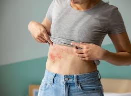 Image result for herpes zoster