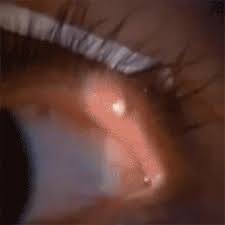 This Is What Popping A Spot Or Stye On The Inside Of Your Eyelid Looks Like Metro News Popping an eye stye has the potential to be riskier than popping a zit. this is what popping a spot or stye