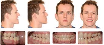 What does blue cross cover for dental? Orthognathic Surgery With Clear Aligner Therapy Oral Health Group