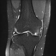 Learn about the veterinary topic of chondromalacia of the femoral condyles in horses. Chondromalacia With Premature Osteoarthritis Image Radiopaedia Org