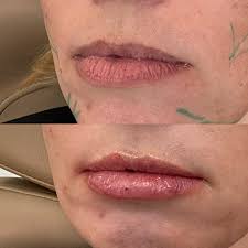 Hydrated Lippies. 💋 Just a little something something for those pesky lip  stick lines. 💋💄 💋 🪬Feel Good, Project Good🪬 ⬇️ To Book⬇️ 💗Injector  Artist Aesthetic💗  https://app.joinmoxie.com/booking/injector-artist-aesthetics 🛜 Injector  Artist ...