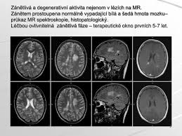Roztroušená skleróza nejdříve napadá ty části těla, které mají na starost koordinaci a pohyb. Ppt Roztrousena Skleroza Mozkomisni V Detskem Veku Powerpoint Presentation Id 4336896