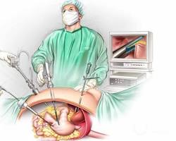 surgeon performing a gastrectomyの画像