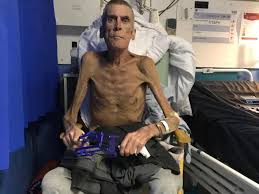 Emaciated man high resolution stock photography and images. Let Down By The System Six Stone Emaciated Man Deemed Fit For Work By Dwp Dies The Independent The Independent
