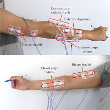 The arms are the most used body parts and they can be subjected to much pressure and strain. Electrode Placement Over The Forearm And Upper Arm Muscles Download Scientific Diagram