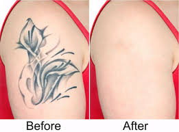 If you're ready to get a tattoo removed, you're not alone: Patel Laser Tattoo Removal