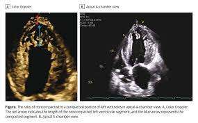 Image result for Left Ventricular Noncompaction