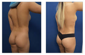 Payments range from $255 to $2,925.15. Brazilian Butt Lift Revision Before And After Dr Mowlavi