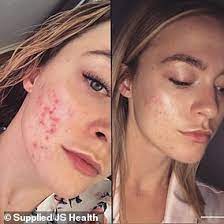Jshealth believes in truly nurturing the body and nourishing it with the right nutrients and herbs to . Student Reveals The Diet And Skincare Regime That Cleared Up Her Embarrassing Acne Using Js Health Newsopener