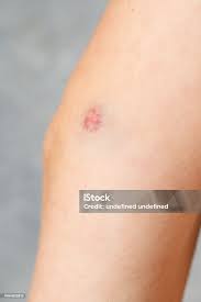 Image result for Skin Trauma