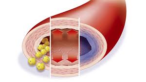 Cholesterin Substanz Mit Folgen Br Wissen