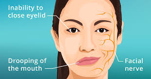Bell's sign shows the eye moves up and out when trying to close eye. Facial Palsy Krina Panchal Physiotherapy And Lifestyle Medicine