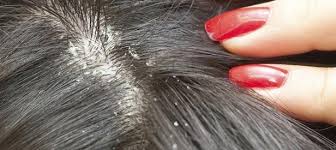 Dandruff Causes And Treatment