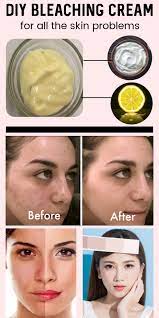 Homemade Bleaching Cream For Skin Lightening And Pigmentation Dark Spots And Glowing Skin Skin Sk Bleaching Cream Skin Bleaching Cream Skin Lightening Cream