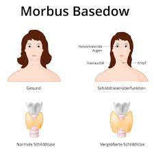 Morbus Basedow Ursachen Symptome Und Behandlung