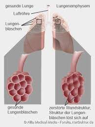They may need to seek medical help at a hospital. Copd Symptome Ursachen Folgen Therapie Netdoktor