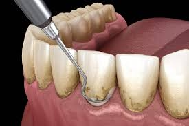 Image result for Gingivitis