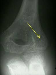 Surgery is recommended for children with displaced medial epicondylar fractures of more than 5 mm. Frx Of The Lateral Condyle In Children Wheeless Textbook Of Orthopaedics