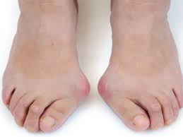 Penyebab telapak kaki sakit yang pertama adalah rematik. Inilah Cara Menghilangkan Bunion Tanpa Operasi