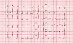 Other tests used to diagnose pericarditis include: Akute Perikarditis Ecg