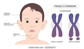 1,3 mil resultados de imágenes, fotos de stock e ilustraciones libres de  regalías para Síndrome de turner