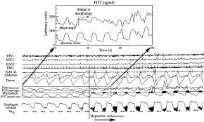 Image result for Polysomnogram