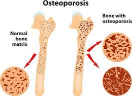 Maybe you would like to learn more about one of these? Osteoporosis Symptoms Treatment Causes Prevention Ead