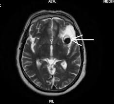 In multe cazuri, poate sa ofere imagini care nu pot fi vizualizate substanta de contrast de la investigatia prin rezonanta magnetica (rmn) nu este alergica spre deosebire de cea. Cazul 19 Anevrism Cerebral Medimar Imagistic Services Rmn Constanta Ct Constantadimar