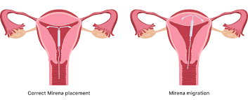 How long does iud pain last. Mirena Side Effects Cysts Expulsion Iud Migration