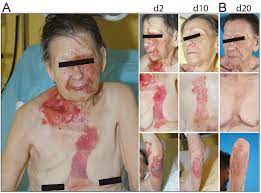 Staphylococcal Scalded Skin Syndrome Caused By A Rare Variant Of Exfoliative Toxin A S Aureus In An Adult Immunocompromised Woman Html Acta Dermato Venereologica