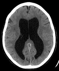 Hydrocephalus Wikem