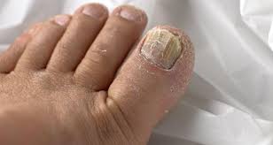 Toenail fungus, or onychomycosis, occurs when fungi infect one or more toenails. Top 5 Home Remedies For Toenail Fungus Thehealthsite Com