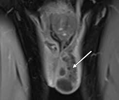 No other focal solid mass was identified in either of the testes. Spectrum Of Extratesticular And Testicular Pathologic Conditions At Scrotal Mr Imaging Radiographics