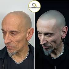 Nuestros resultados de micropigmentación capilar