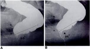 Defecogram Shows Spastic Pelvic Floor Syndrome In 66 Year Old Man With Download Scientific Diagram